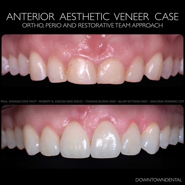 Ceramic Before & After